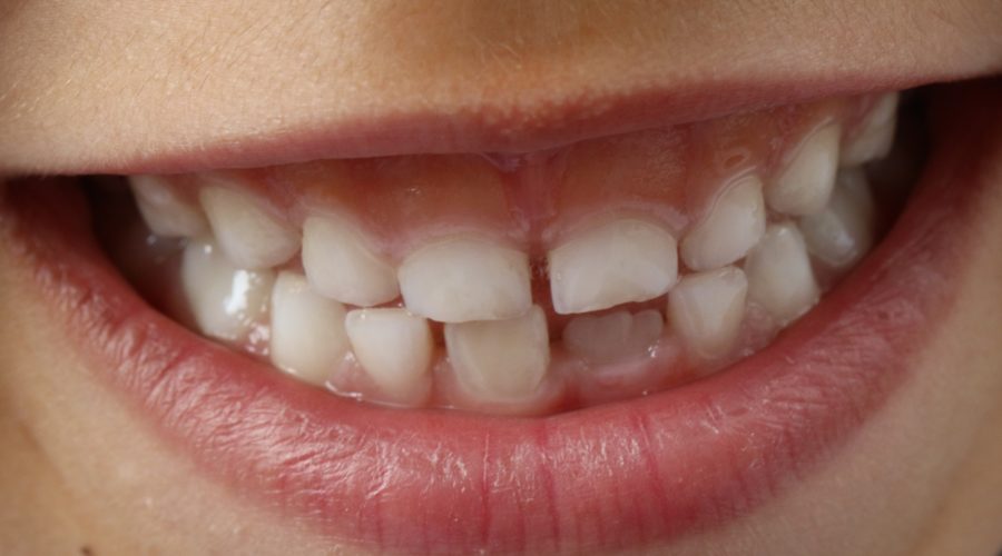 Childhood Tooth Decay: What Parents Should Know